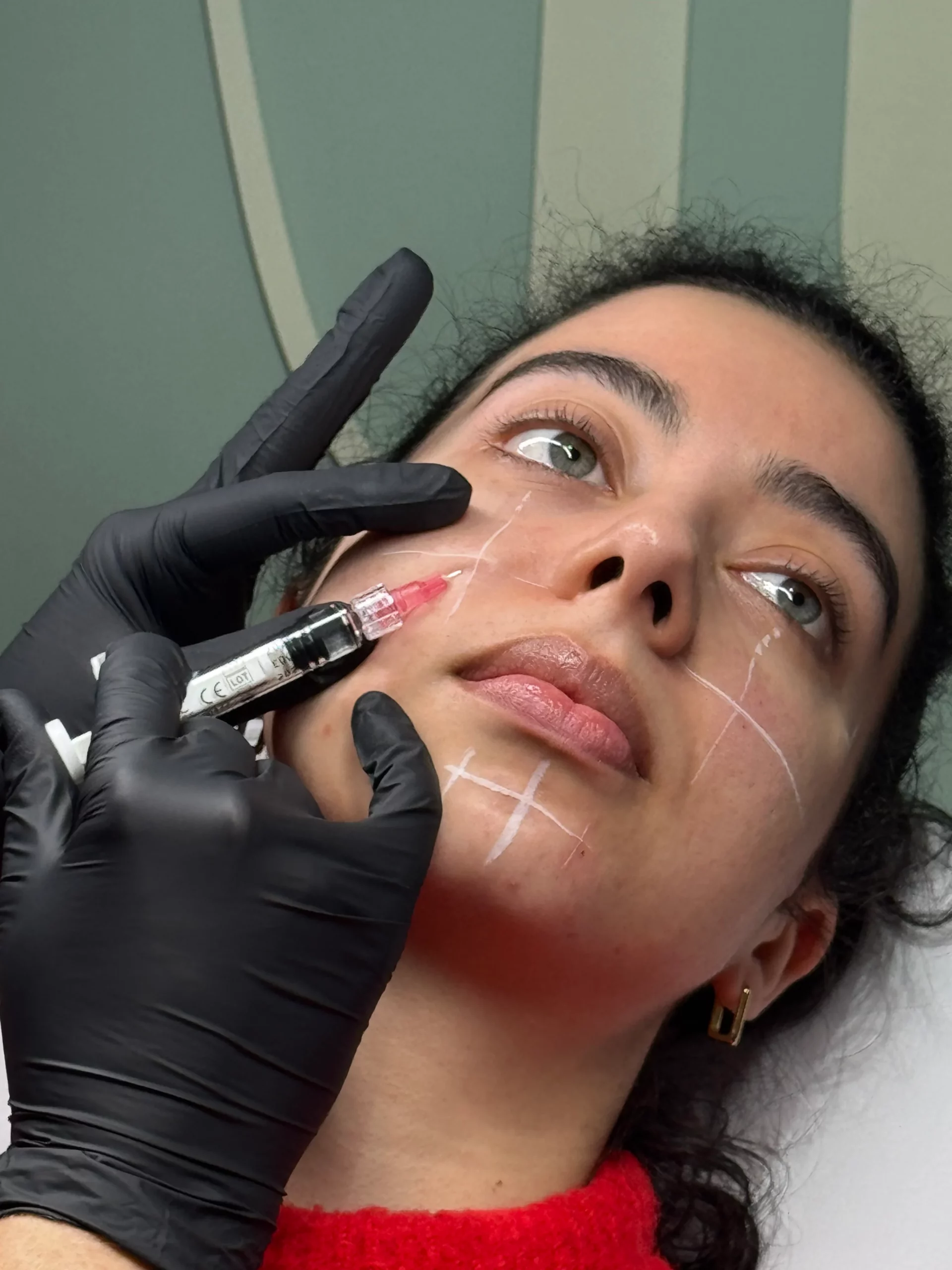 Nurse performing a Profhilo hyaluronic acid injection on a client's jawline