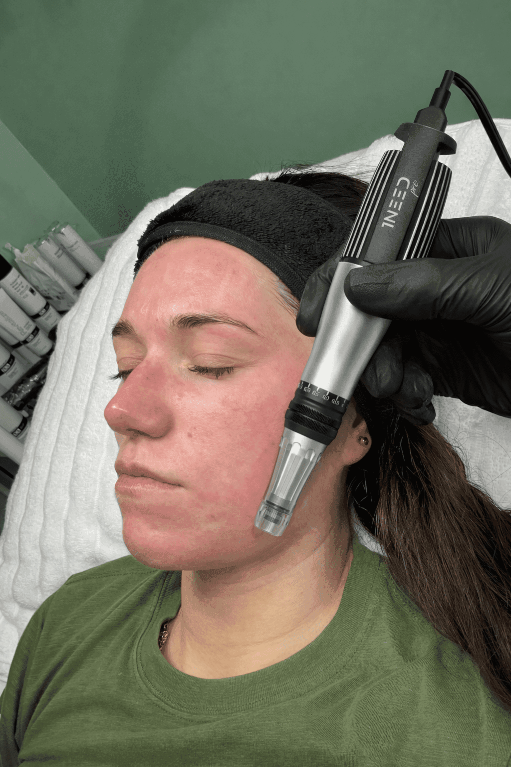Close-up of a microneedling device being used on a client's forehead